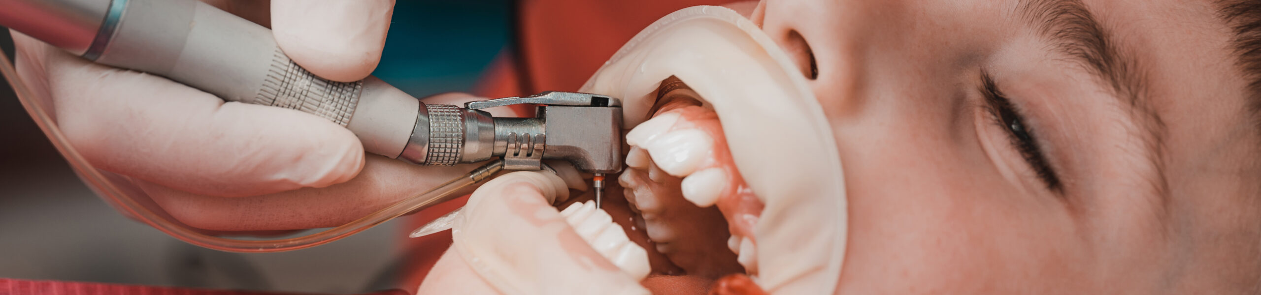 Profilaxia dentara la copii si adolescenti